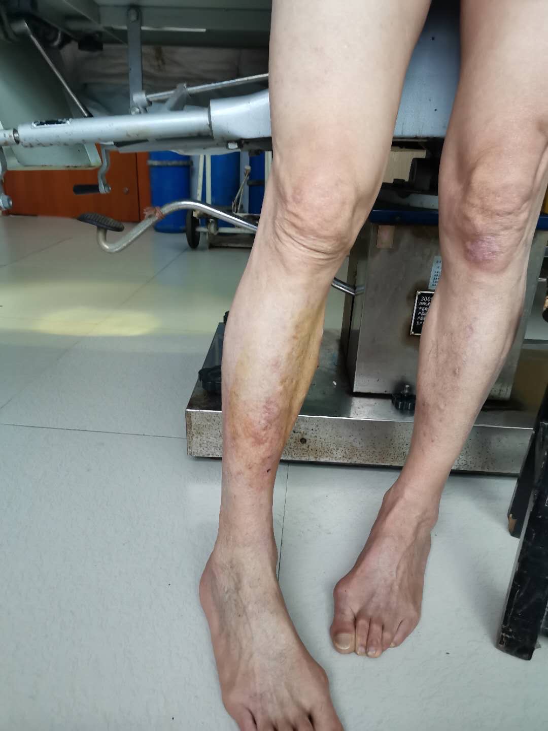 寶寶穿學步襪好還是學步鞋好_淄博靜脈精索曲張_穿彈力襪能治好靜脈曲張嗎
