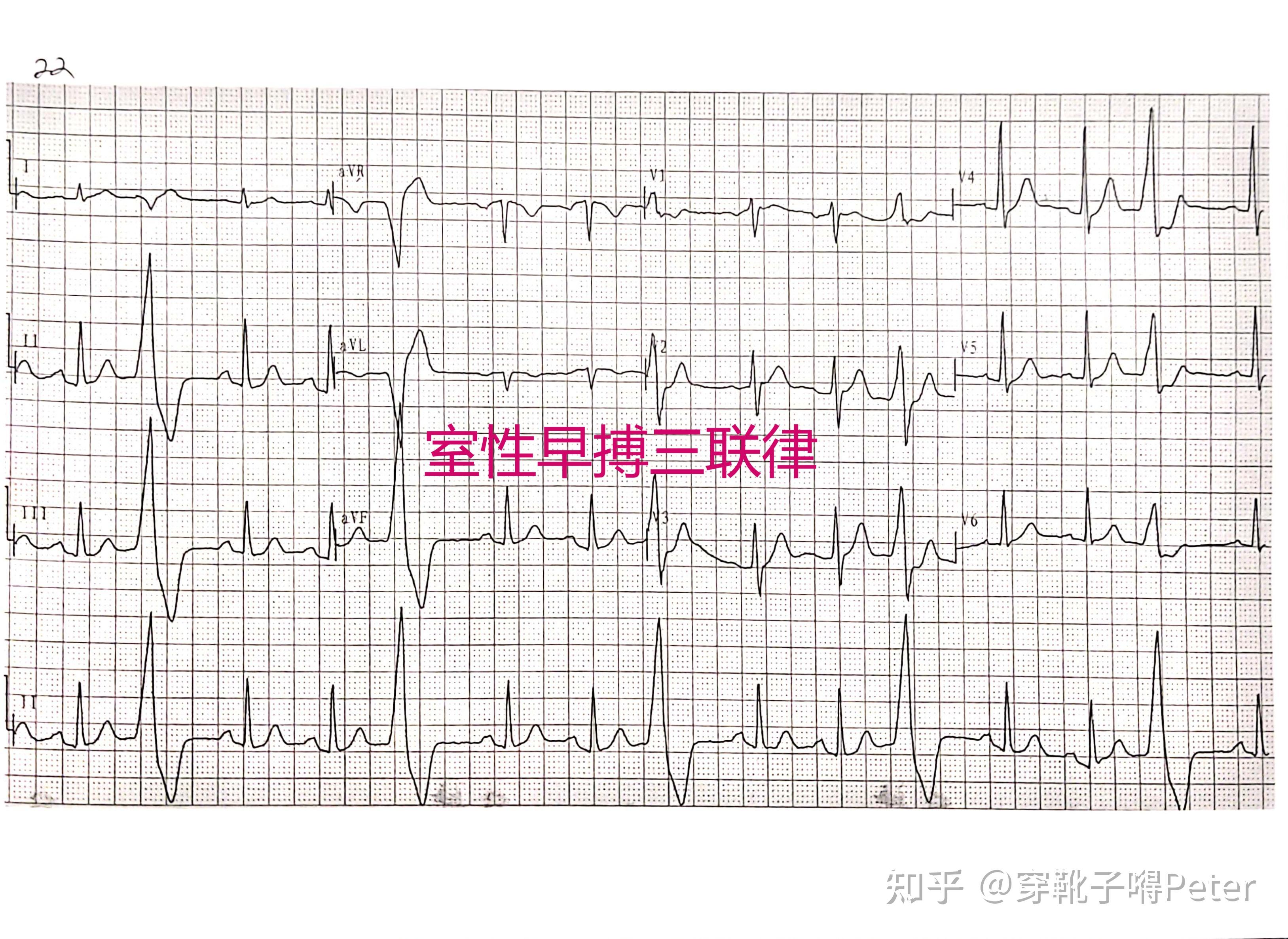 鈣依賴性鉀通道是什么_第三類鉀通道阻滯劑_鉀通道阻滯劑有哪些藥