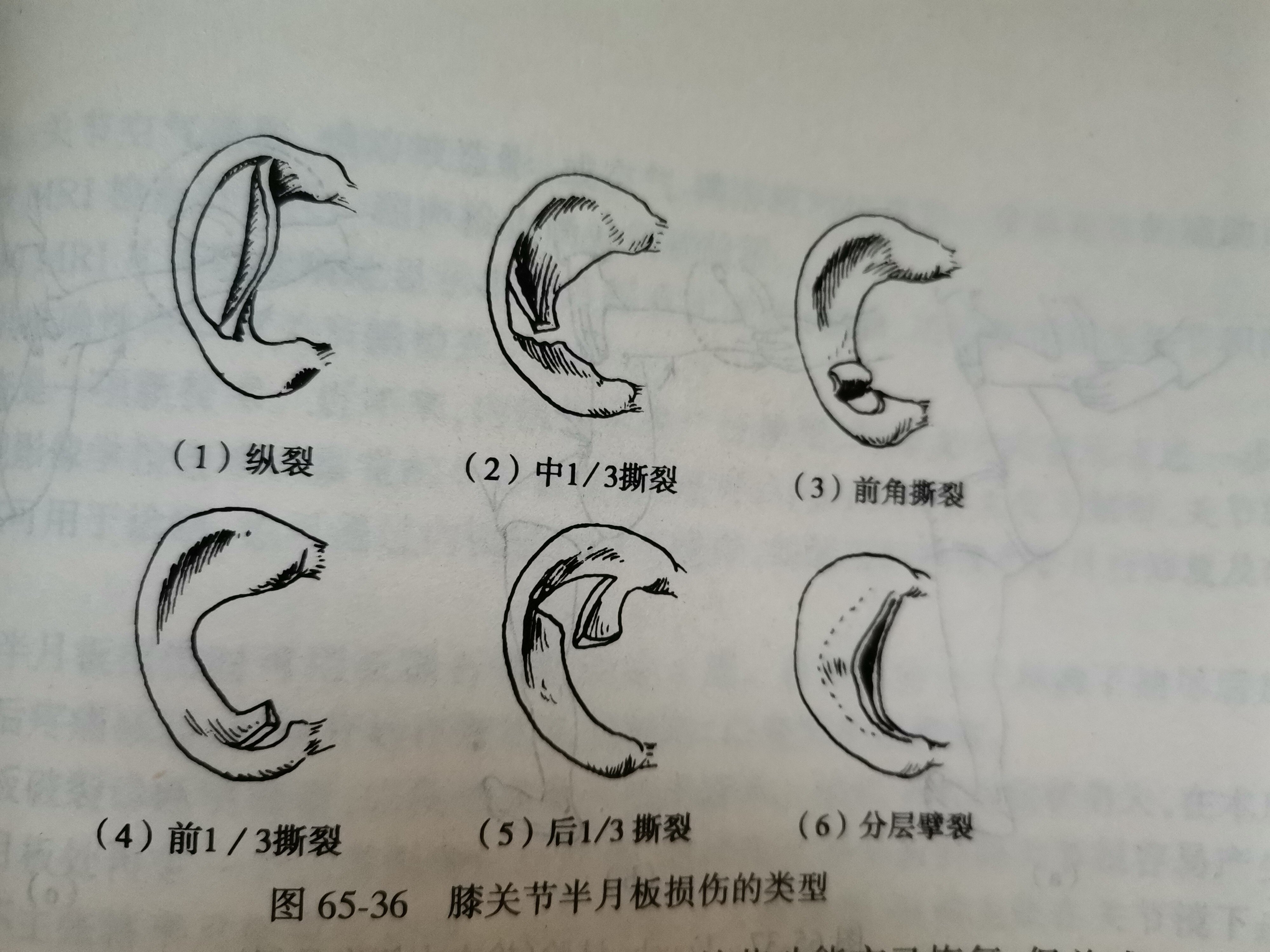 彈力繃帶治療膝關節炎_彈力繃帶纏膝蓋半月板_膝部彈性繃帶怎么綁