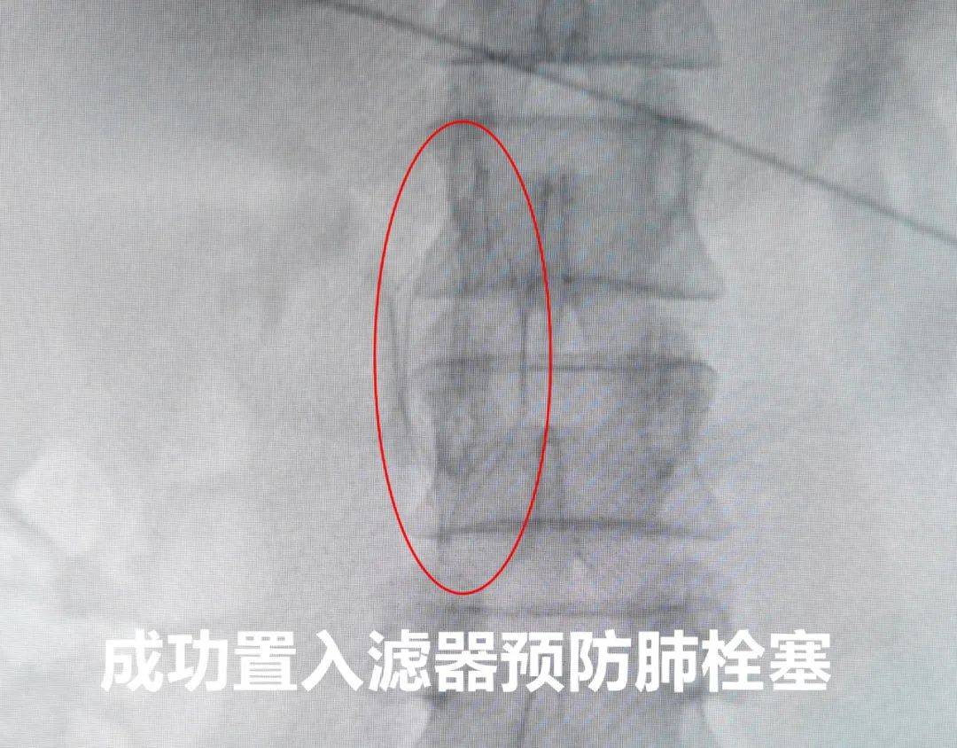 彈力繃帶可以重復使用嗎_彈力繃帶康復用的_彈力重復繃帶使用可以長期用嗎